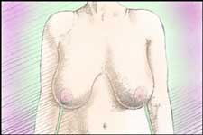 La chirurgia di riduzione del seno allevia le spiacevoli sensazioni fisiche causate dai seni troppo grossi