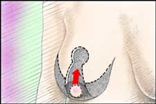 le incisioni seguono il naturale contorno del seno e determinano la zona di asportazione e la nuova posizione del capezzolo