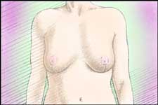 Mastoplastica riduttiva dopo l'intervento le mammelle saranno piu proporzionate al resto del corpo. Le cicatrici sono permanenti ma si affievoliscono col tempo