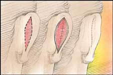 no fatte e viene rimossa una piccola parte di cute, a volte con il grasso sottostante. (b) La cartilagine viene ricontornata per portare l'orecchio nella sua posizione corretta, e supportata con delle suture. (c) Alcuni punti chiudono l'incisione, lasciando una pallida cicatrice, che si nasconde nelle naturali pieghe retroauricolari.