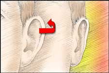 la chirurgia vista dal davanti dell'orecchio. La cartilagine rimodellata ripristina la piega dell'orecchio, avvicinandolo alla testa.